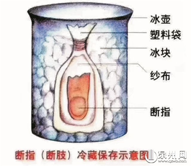 5岁男童被搅拌机绞断三根手指 十余小时手术后接回