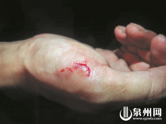 公益人员庄先生被大狗咬伤手掌